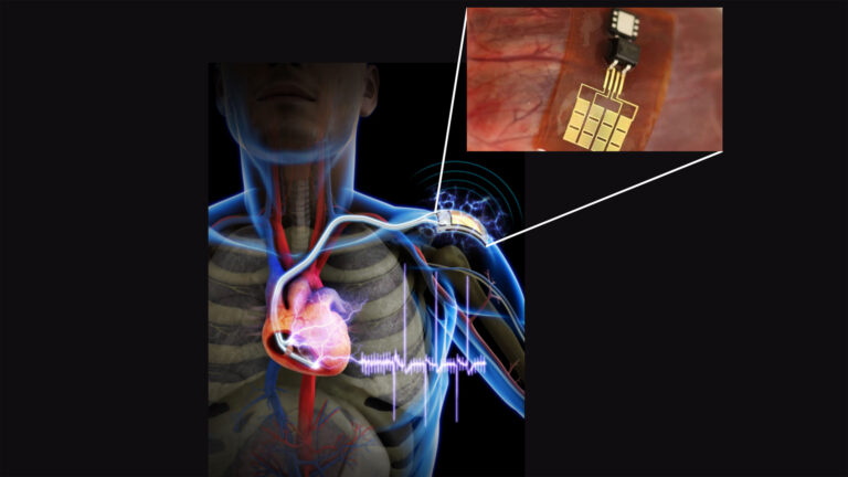 Piezoelektrik malzemelerle pilsiz kalp pilleri